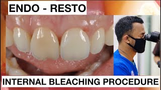 Step by Step Internal Bleaching Teeth Discoloration  Direct Restoration  General Dentist Griya RR [upl. by Amekahs]