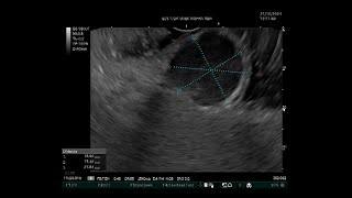 EUSGuided Fine Needle Aspiration FNA of a Gastric Submucosal Lesion [upl. by Dode201]