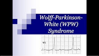 ECG Tip 19 What happens with WPW to look like this in ECG [upl. by Ffoeg830]