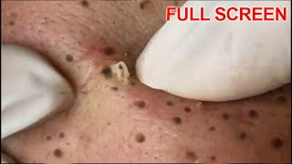 Blackheads Removal  Best Pimple Popping Videos [upl. by Mlehliw]