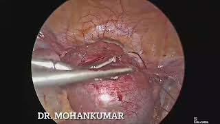 Cornual pregnancy 12 weeks [upl. by Johansen]