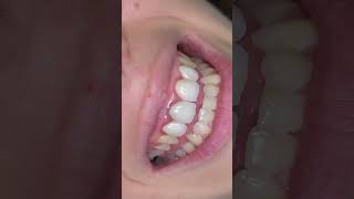 eMax Crowns amp NoPrep eMax Veneers [upl. by Daffodil]