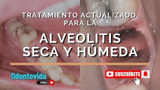 Tratamiento Actualizado para la Alveolitis Seca y Húmeda Limpieza Medicación y Apósitos [upl. by Jaala]