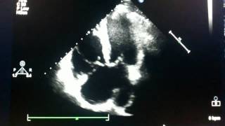 Echocardiogram  ostium primum atrial septal defect [upl. by Trela83]