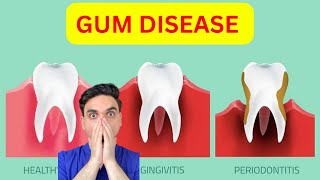 Gingivitis Vs Periodontitis Watch This Before It is TOO LATE [upl. by Yarvis]