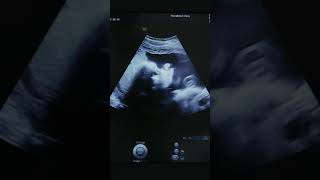 Ultrasonography  Medical ultrasound includes diagnostic imaging techniques  Digital Technologys [upl. by Anerok]