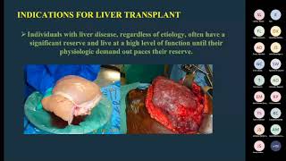 2022 ABSITE Review Transplant [upl. by Aniratak979]