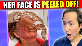 Plastic Surgeon Reacts to Face Peeling Off Videos phenol peel [upl. by Kerek]