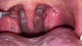 HUGE TONSIL STONES REMOVED [upl. by Amargo]