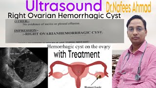 Ultrasound Right Ovarian Hemorrhagic Cyst doctor motivation viral ultrasound treatment [upl. by Ardnajela]