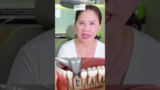 Nữ Việt kiều Mỹ sau khi BỌC RĂNG SỨ TOÀN HÀM  TRỒNG RĂNG IMPLANT tại JW tự tin cười sang [upl. by Aisats]