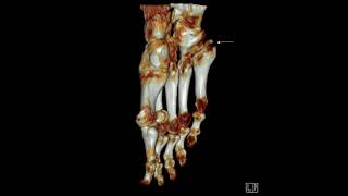 5th metatarsal base fracture [upl. by Aisenet]