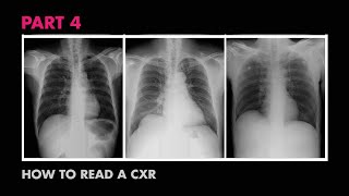 Assessment of CXR Positioning amp Views  How to Read a Chest XRay Part 4  MEDZCOOL [upl. by Theresa98]