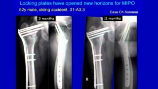 Complex Proximal Femur Fractures [upl. by Schnorr683]