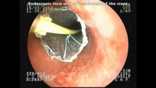 Positioning without fluorscopic esophageal SEMS [upl. by Einnal22]