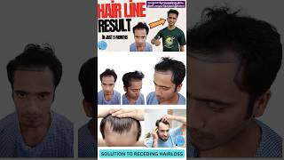 Good hair growth in just few months shorts short hairtransplant hair chennaihairplant [upl. by Luckin]