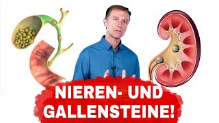 Ursachen von Gallen und Nierensteinen und wie man sie vermeidet  Dr Berg Deutsch [upl. by Halyak]