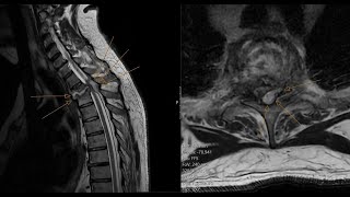 Spinal epidural abscess  spondylodiscitis  insufficiency spinal fracture CT and MRI correlation [upl. by Korenblat151]