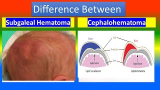 Variation Between Subgaleal Hematoma and Cephalohematoma [upl. by Nations]