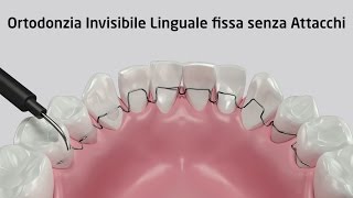 Ortodonzia Invisibile Linguale fissa senza Attacchi  Zerodonto [upl. by Ybreh]