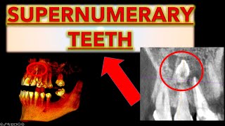 How to Make Sure it is a Supernumerary Tooth Extra teeth in mouth hyperdontia extra front teeth [upl. by Nove]