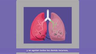 Vídeo 4  El trasplante en la Fibrosis Quística [upl. by Alexandrina]