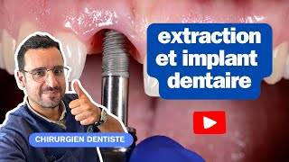 Extraction et implantation immédiate  une solution optimale [upl. by Nya598]