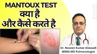 Mantoux Test क्या है और कैसे करते है  Mantoux tuberculin skin test TST TB Test  Diagnosis of TB [upl. by Einnek]