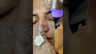 What does a Hydra facial do  Hydrafacial Step By Step Procedure [upl. by Swor]