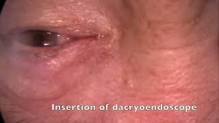 Lacrimal duct parameters based on dacryocystography  Supplementary video ID 370800 [upl. by Baniez]