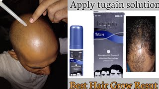 How To Apply Cipla Tugain Men Solution। Best Result। Sonu Kumar Mishra। [upl. by Estis425]