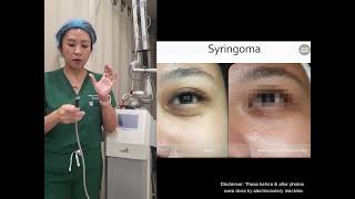 How do we remove syringoma in the clinic [upl. by Priest193]