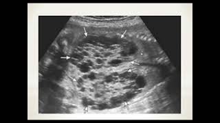 Fetal Dysplastic kidney [upl. by Tsnre]