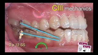 Solving anterior Crossbite with Aligners｜【Chris Chang Ortho】CC808 [upl. by Ragland]