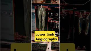 Lower limb angio VRT images vrt angiogram 3d ctangiography ctscan angiography anatomy [upl. by Vern]