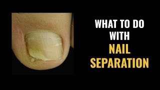 NAIL SEPARATION  What to DO and What are the CAUSES [upl. by Anyrb481]