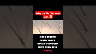 Why do We Get acne skin 🤯 acne acnetreatment acnecauses trendingshorts viral facts foryou fy [upl. by Ram595]