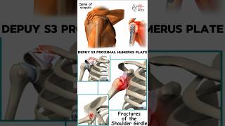 Depuy S3 Proximal Humerus Plate  medical animation 3d short [upl. by Illoh]