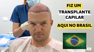 TUDO SOBRE MEU TRANSPLANTE CAPILAR [upl. by Oicneconi]