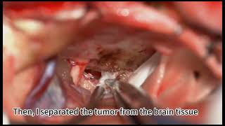 Lateral Frontal Approach for Resection of Small Tuberculum Sella MeningiomaJianfu Zhang [upl. by Teews]