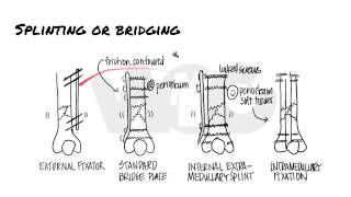 Principles of Fracture Fixation  Orthopedic Basics [upl. by Akemrej214]