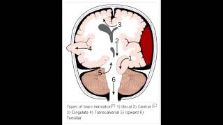 Herniation Syndromes  Cingulate subfalcine Transtentorial Uncal amp Cerebellar Tonsillar [upl. by Nwahc]