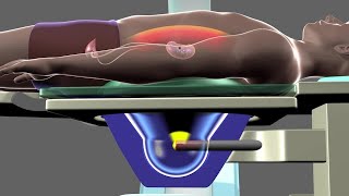 Shockwave Lithotripsy [upl. by Cuthbertson391]