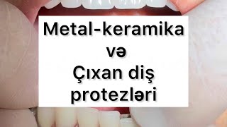 Metal keramika və çıxan diş protezləri [upl. by Ayiak]