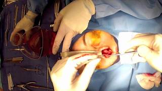 quotOpenquot Rhinoplasty Part 6 Narrowing nasal tip cartilages Cephalic Trim  Maryland Virginia [upl. by Amitie]