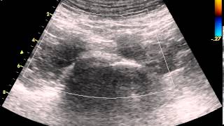 Transverse scan of the normal abdominal aortic bifurcation [upl. by Aina826]