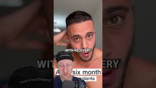 Six Month Hair Transplant Result  Plastic Surgeon Reacts [upl. by Leunas248]