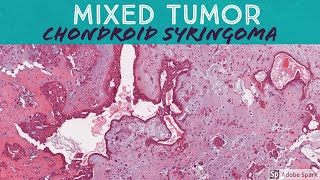 Chondroid Syringoma Mixed Tumor 5Minute Pathology Pearls [upl. by Gnivri517]