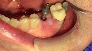 FLAPLESS IMPLANT Implante dental con una técnica sin colgajo [upl. by O'Gowan437]