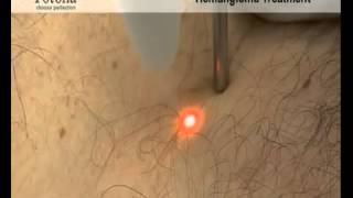 Hemangioma Removal with Fotona Laser  rtwskin [upl. by Oilla]